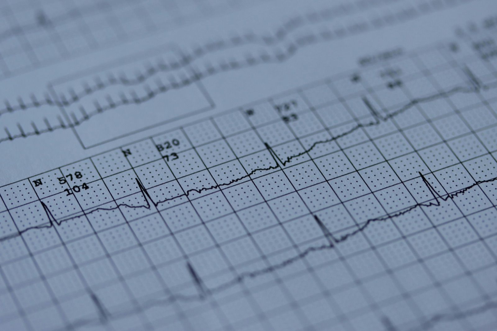 A printed ECG rhythm strip, representing clinical chart review